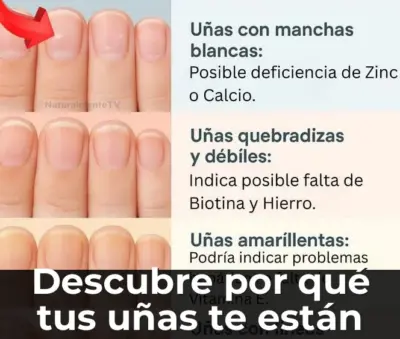 Uñas débiles y quebradizas necesitan cuidado